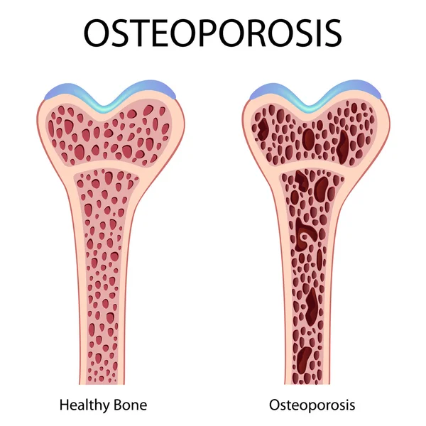 Osteoporose — Vetor de Stock