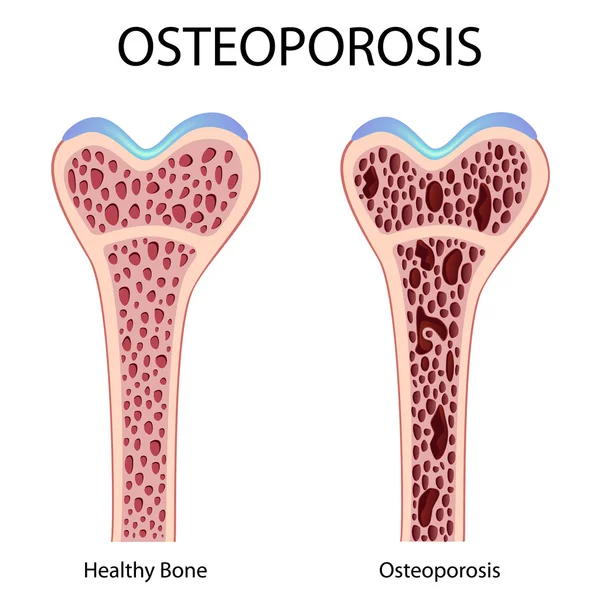 Ostéoporose — Image vectorielle