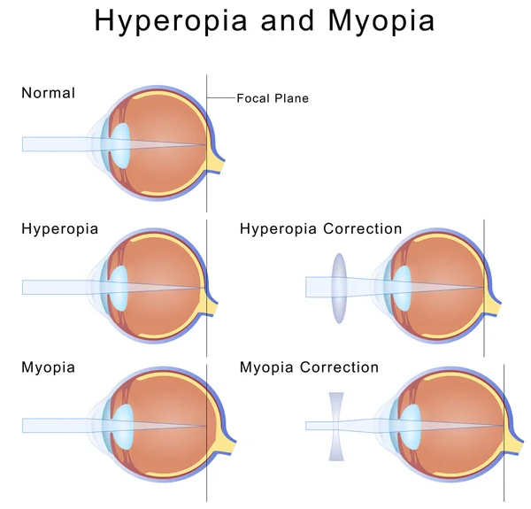 Miyopi ve hipermetropi — Stok Vektör