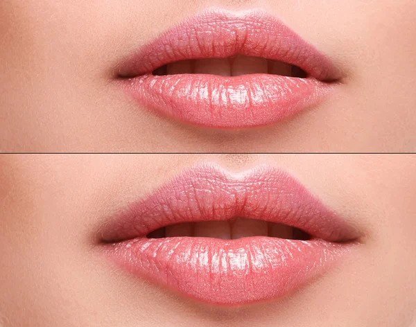 Lips  before and after augmentation — Stock Photo, Image