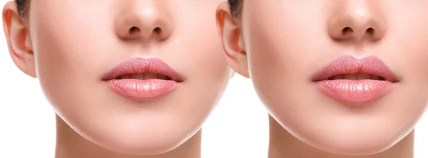 Lips  before and after augmentation — Stock Photo, Image