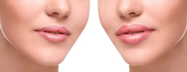 Lippen vor und nach der Augmentation Stockfoto