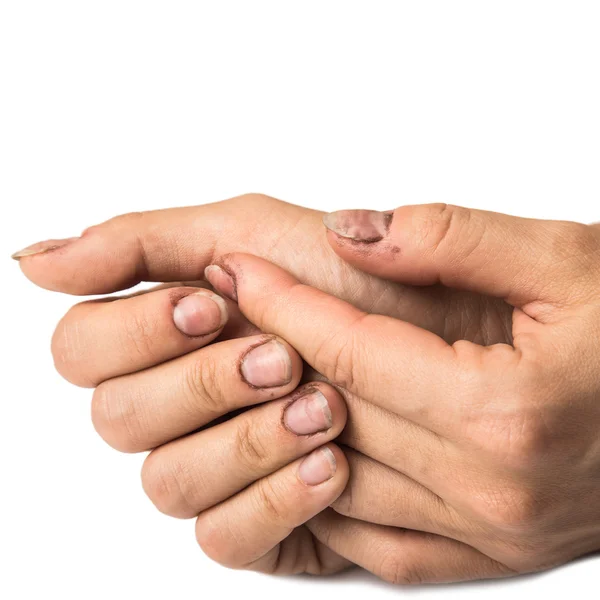 Mãos femininas com unhas sujas — Fotografia de Stock