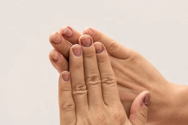 Female hands with dirty nails — Stock Photo, Image