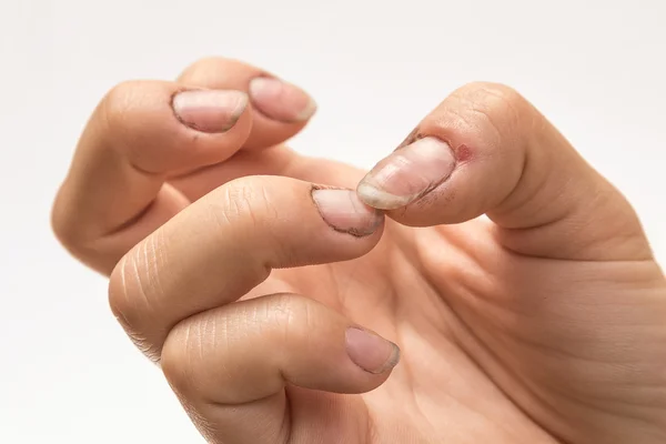 Mãos femininas com unhas sujas — Fotografia de Stock