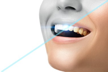 Diş beyazlatma ve hijyen. Profesyonel diş sağlığı kliniğinde tedavi sonrası sonuç.