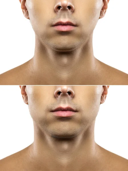 Male Chin White Background Surgery Mewing Exercises Result Jawline Reshape — Stock Photo, Image