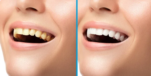 Wybielanie Zębów Higiena Wynik Leczeniu Profesjonalnej Klinice Stomatologicznej — Zdjęcie stockowe