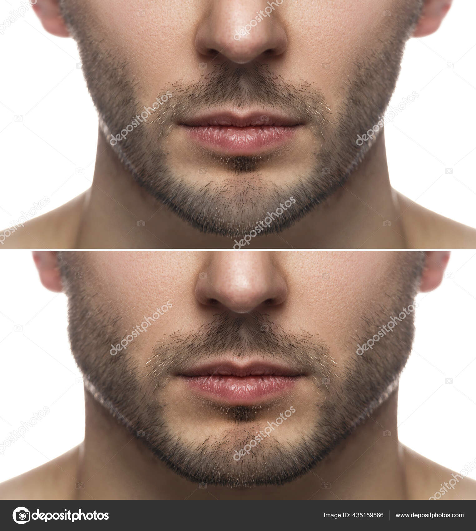 Surgery Mewing Exercises Result Jawline Reshape Stock Photo by ©AY_PHOTO  435159566