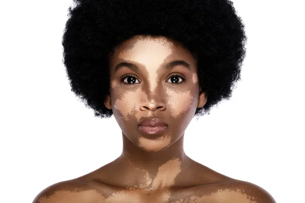 Portret Młodej Pięknej Czarnej Kobiety Zaburzeniami Skóry Kręgosłupa — Zdjęcie stockowe
