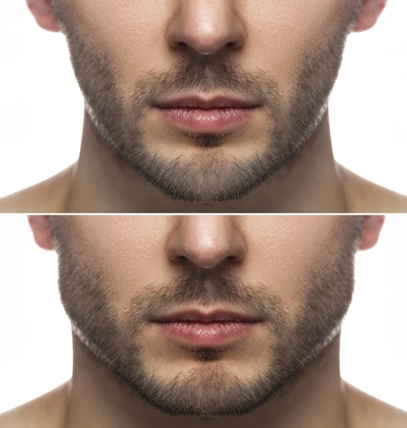 手術や瞑想の演習 顎の形状の変更の結果 — ストック写真