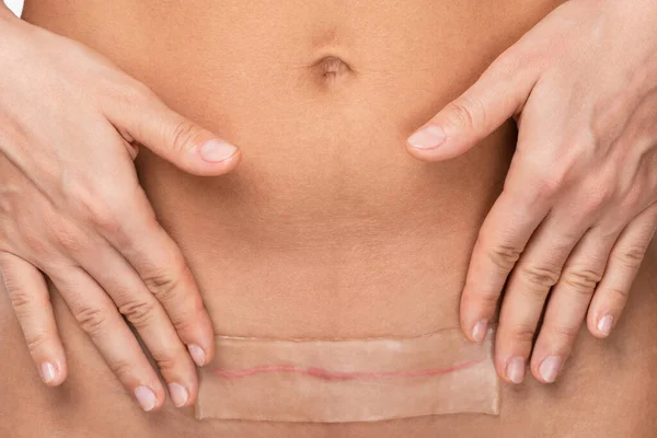 Vrouw Het Aanbrengen Van Patch Met Een Siliconen Plaat Haar — Stockfoto