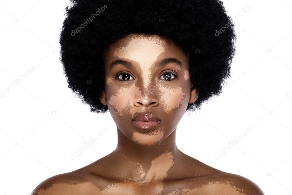 Portrait of young and beautiful black woman with vitiligo skin disorder