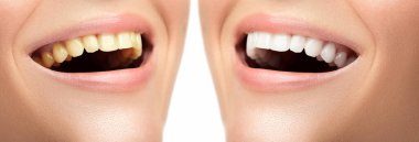 Diş beyazlatma ve hijyen. Profesyonel diş sağlığı kliniğinde tedavi sonrası sonuç.