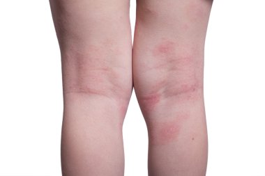 Eczema on the kid's legs clipart