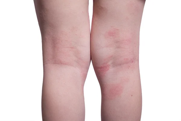 Eczema on the kid's legs — Stock Photo, Image