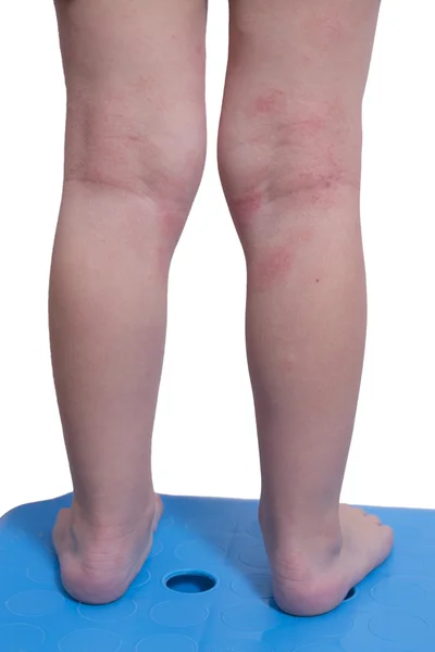 Eczema on the kid's legs — Stock Photo, Image