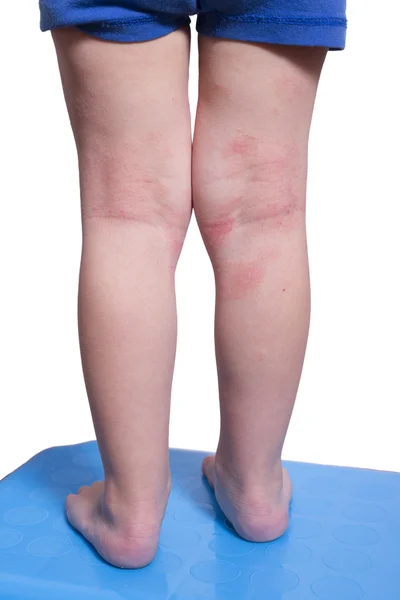 Eczema on the kid's legs — Stock Photo, Image