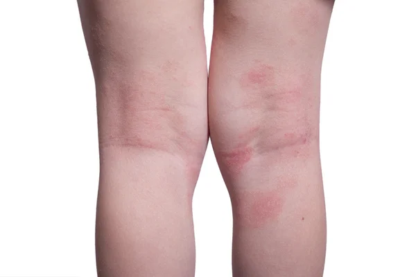 Eczema sulle gambe del bambino Foto Stock