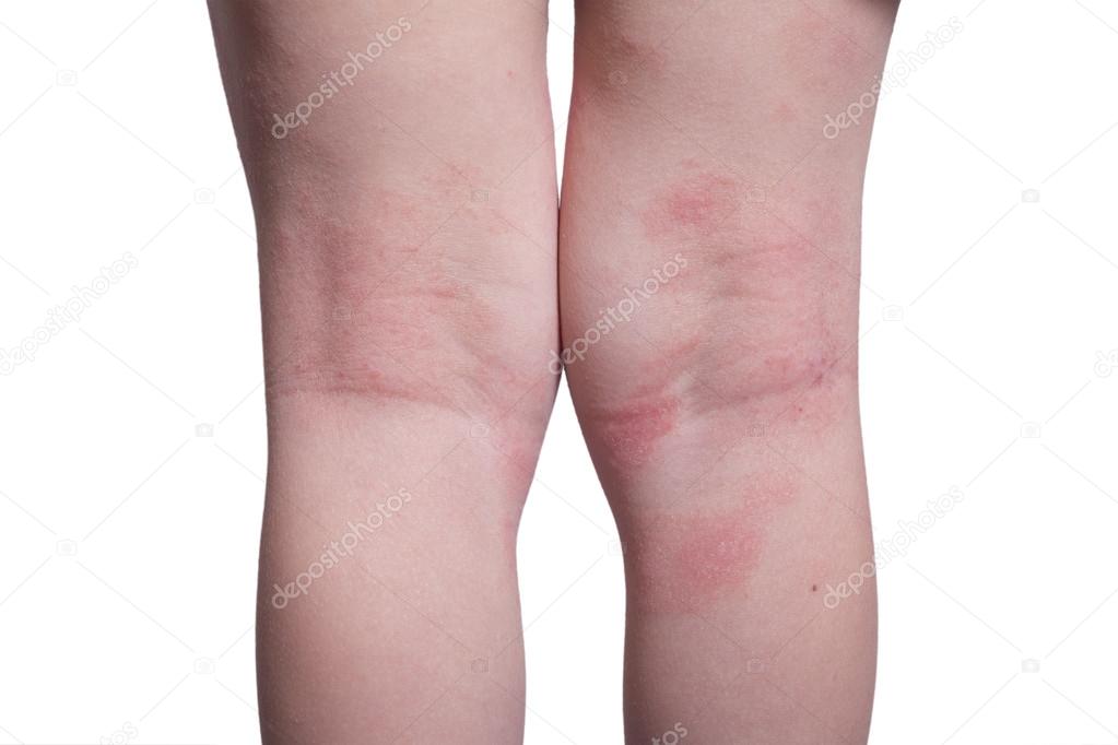 Eczema on the kid's legs