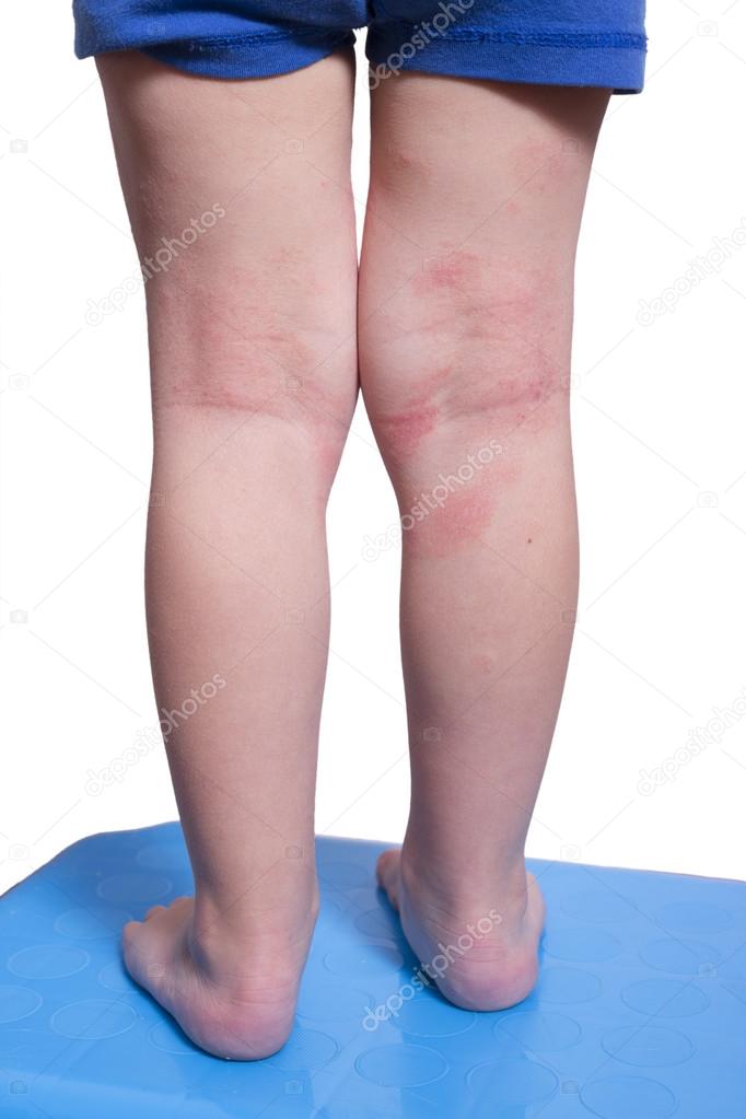 Eczema on the kid's legs