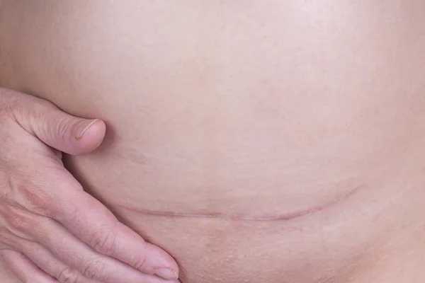 C section scar — Stock Photo, Image