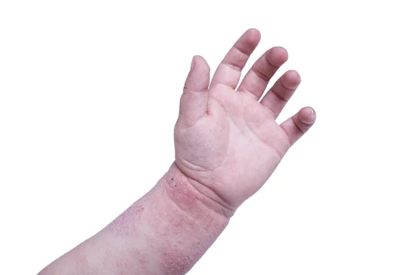 Eczema na mão do garoto — Fotografia de Stock
