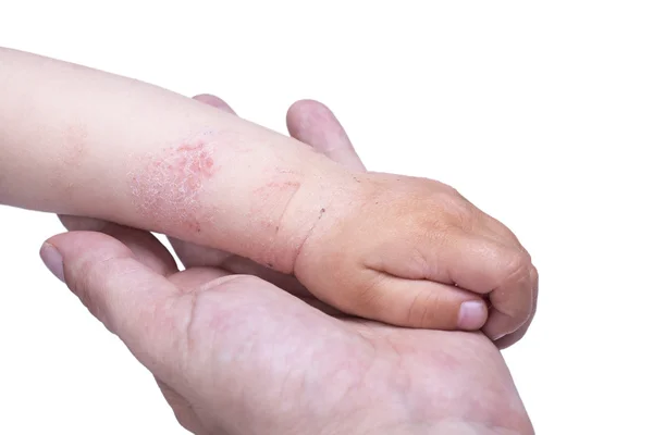 Eczema na mão do garoto — Fotografia de Stock