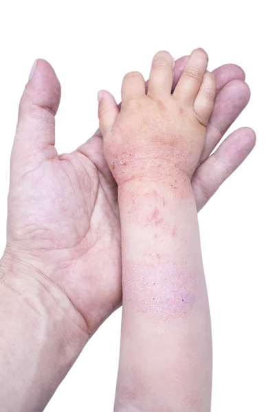 Eczema na mão do garoto — Fotografia de Stock