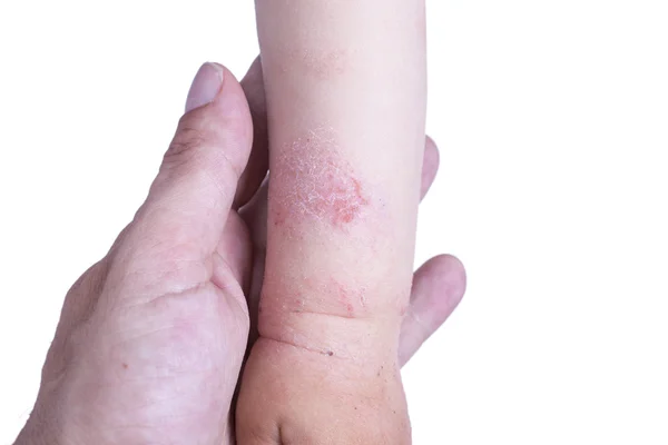 Eczema sulla mano del bambino Fotografia Stock