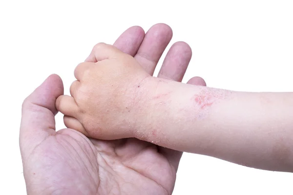 Eczema sulla mano del bambino Immagine Stock