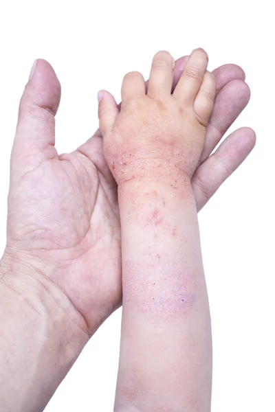 Eczema sulla mano del bambino Foto Stock
