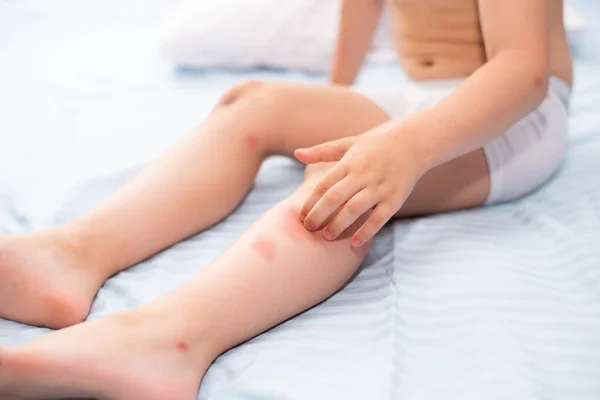 Piedi Bambini Allergici Dalle Punture Zanzara Grandi Punture Zanzara Ferite — Foto Stock