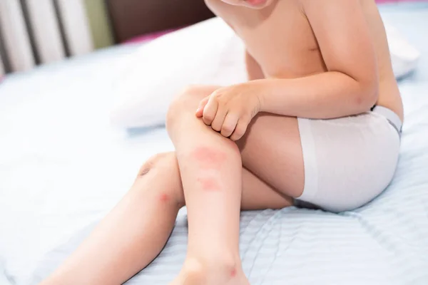 Kindervoeten Allergisch Voor Muggenbeten Grote Muggenbeten Doen Pijn Aan Kindervoeten — Stockfoto