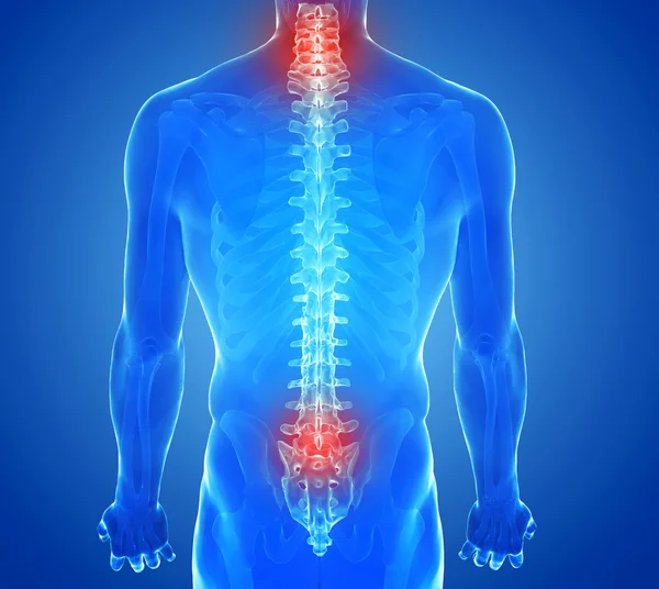 X-ray view of Spine pain - vertebrae trauma — Stock Photo, Image