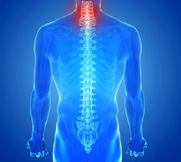 X-ray weergave van rug pijn - wervels trauma — Stockfoto