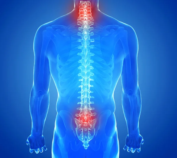 Рентген боли в позвоночнике - травма позвоночника — стоковое фото