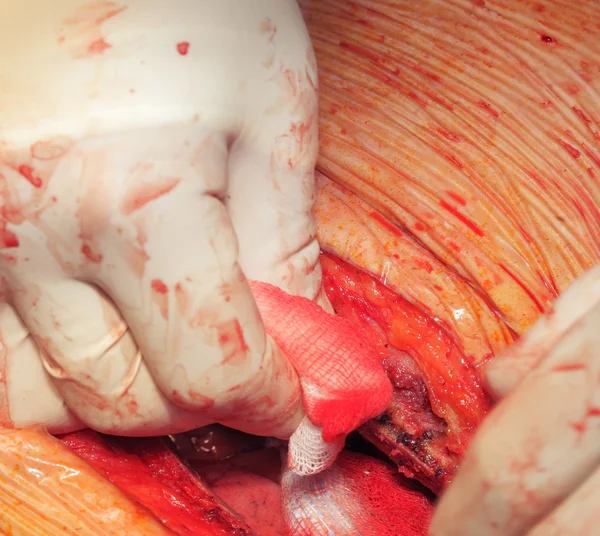 Zastavit krvácení během operace — Stock fotografie