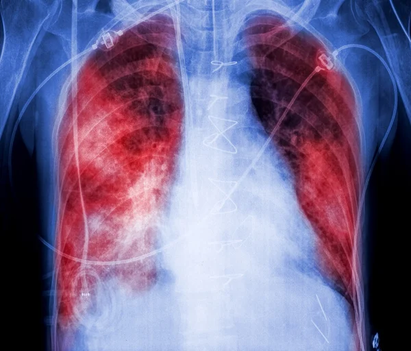 X-rays with lungs marked red color — Stock Photo, Image