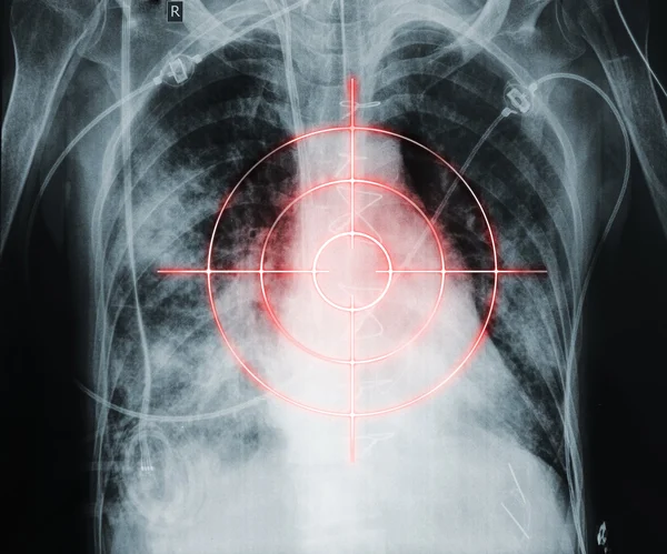 Estilo de vida pouco saudável destinado a danos cardíacos — Fotografia de Stock