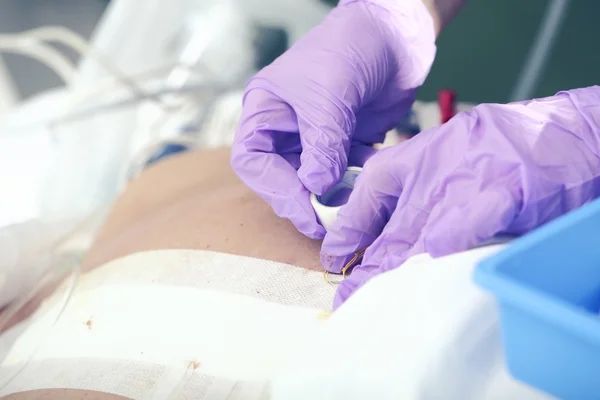 Перевязывание послеоперационной раны пациента — стоковое фото