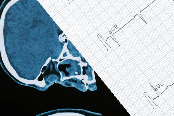 Fragment of CT scann and cardiogram — Stock Photo, Image