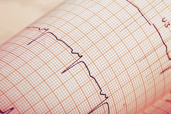 Kayıt EKG kağıt üzerinde