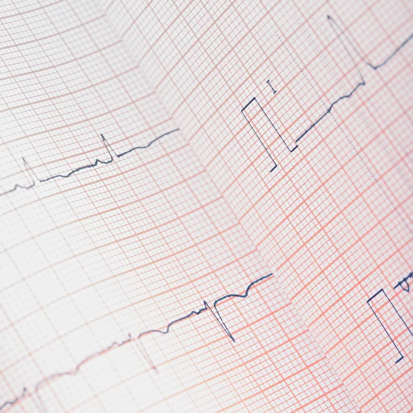 EKG kağıt incelenmesi için eğildi — Stok fotoğraf