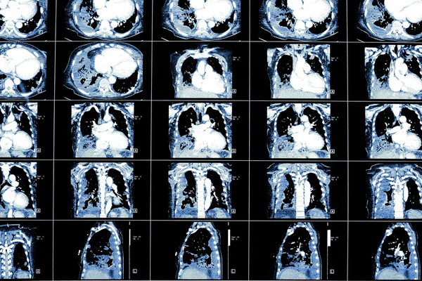 Datortomografi av patientens bakgrund — Stockfoto