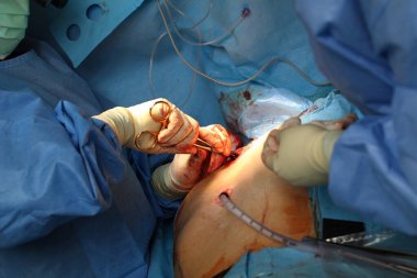 Gerçek bir operasyon çerçevesi. Cerrahlar iş başında.