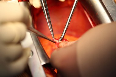 Kardiyovasküler cerrahide aletlerle çalışmak