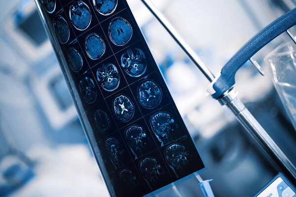 MRI film of human brain hanging on the tripod in the hosptal ward. 