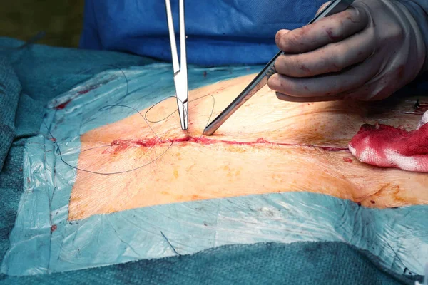 Cirurgião Fechou Duas Bordas Incisão Com Fio Cirúrgico Após Operação — Fotografia de Stock