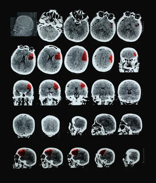 AVC ischémique du cerveau humain CT. Avec le rouge montre le affecté un — Photo